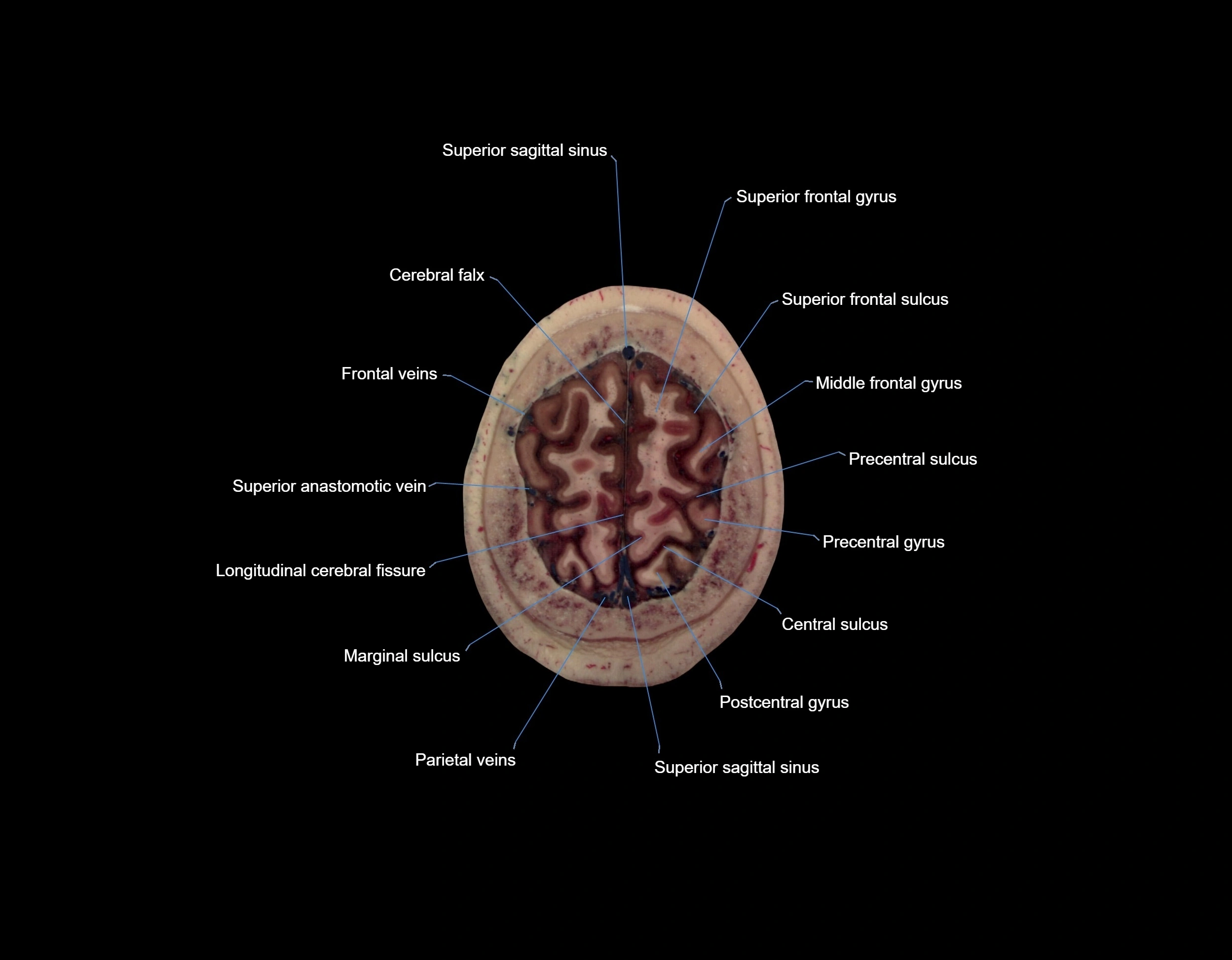 MRI Brain axial cross sectional radiology anatomy 3T image  -img-000070.webp